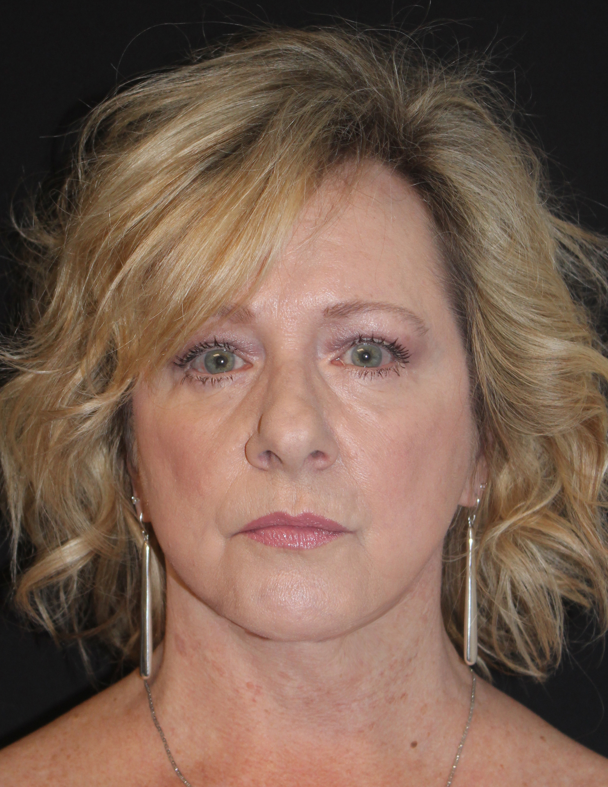 Patient 79 After Image