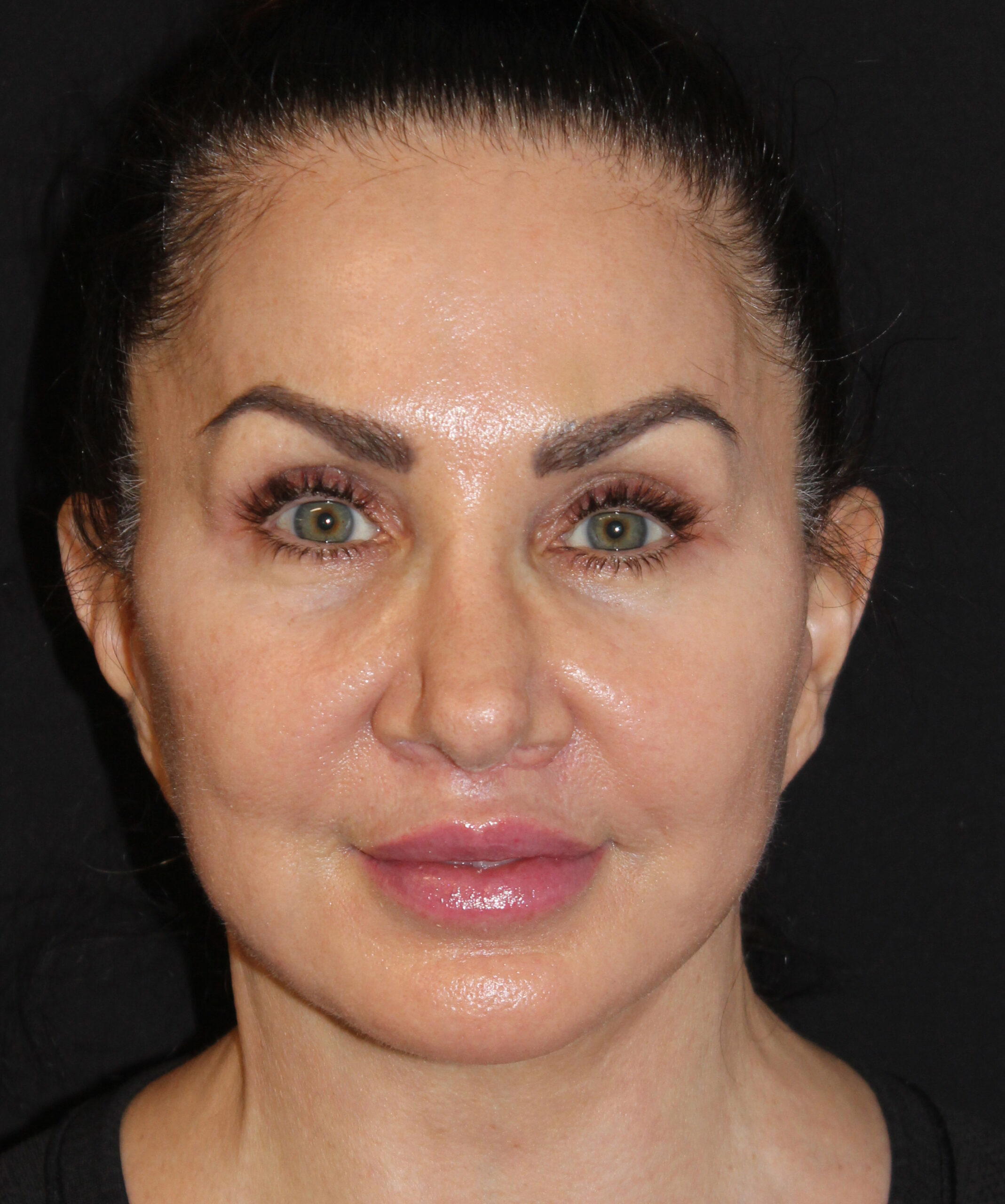 Patient 107 After Image