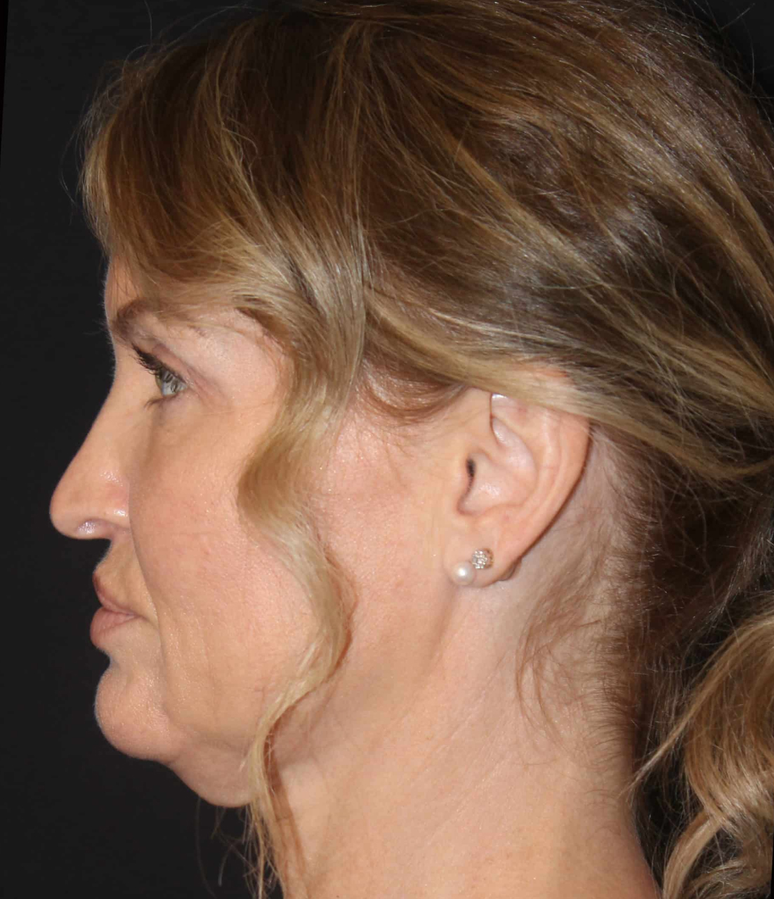 Patient #91 Before Image