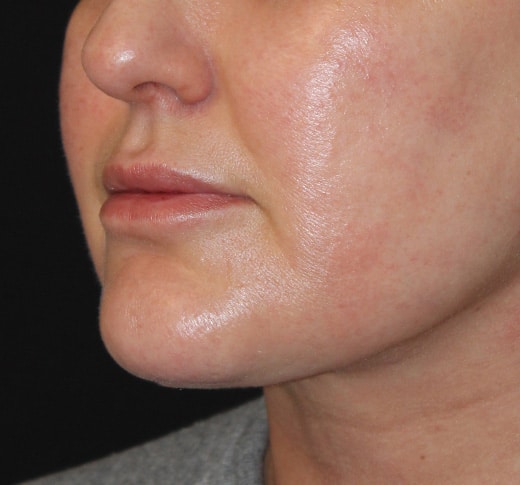 Patient 95 After Image