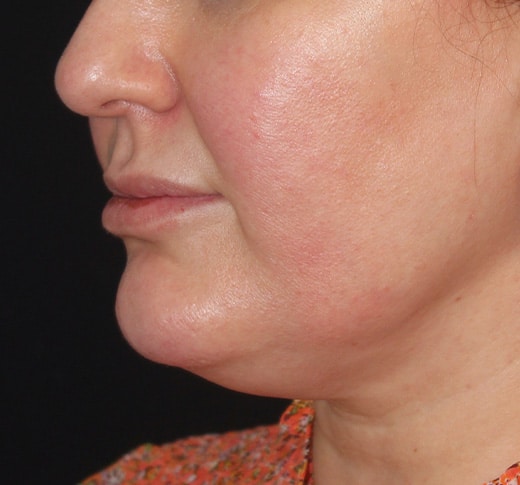 Patient 95 Before Image