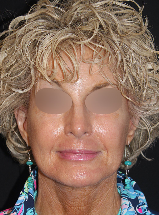 Patient 82 After Image