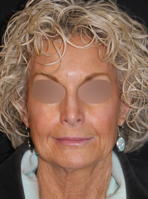 Patient 82 Before Image