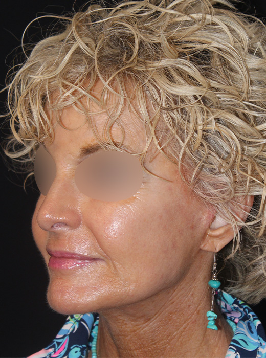 Patient 82 After Image