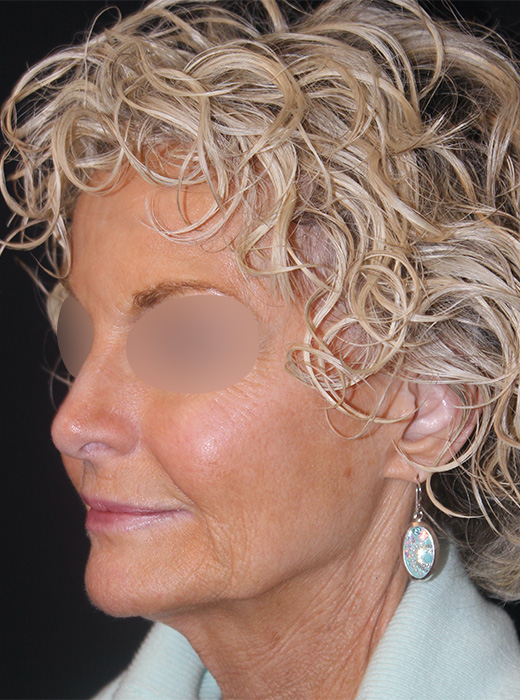 Patient 82 Before Image