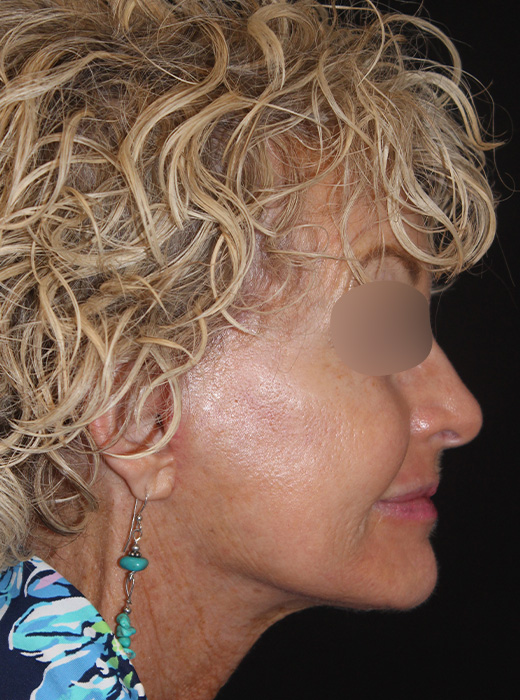 Patient 82 After Image