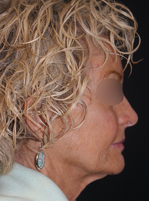 Patient 82 Before Image