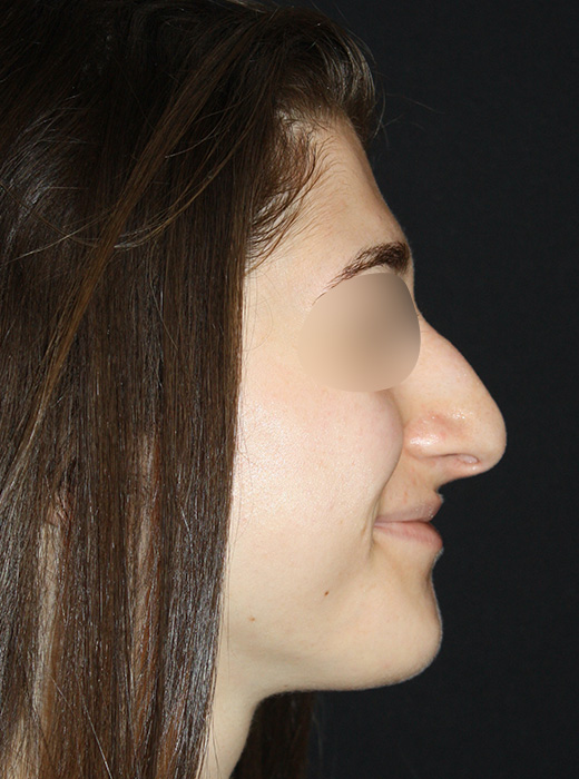 Patient 58 Before Image