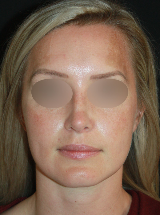 Patient 72 After Image