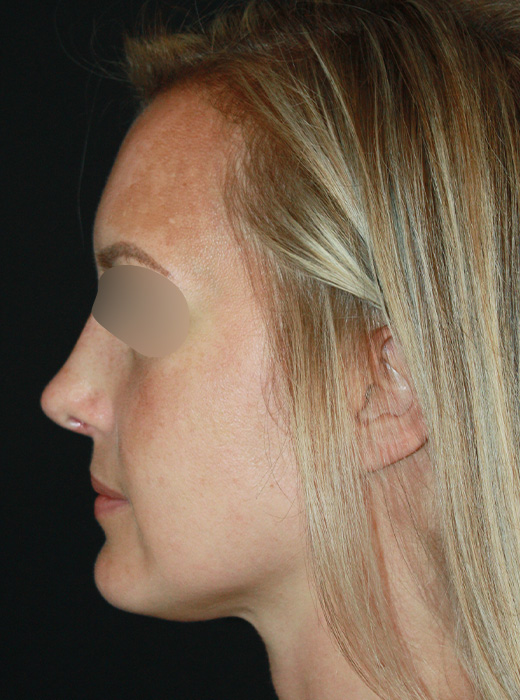 Patient 72 After Image