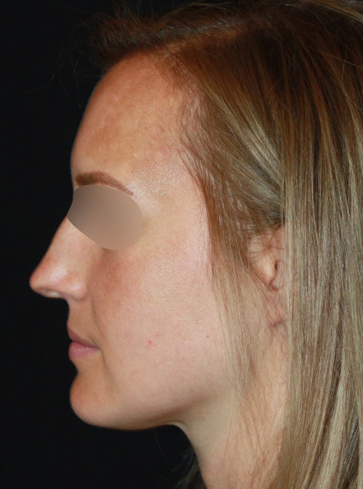 Patient 72 Before Image