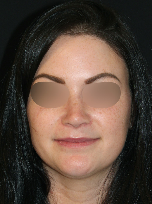 Patient 77 After Image