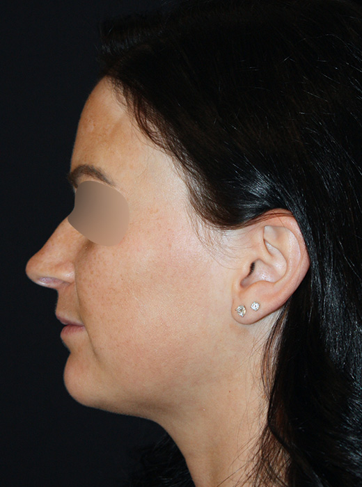 Patient 77 Before Image