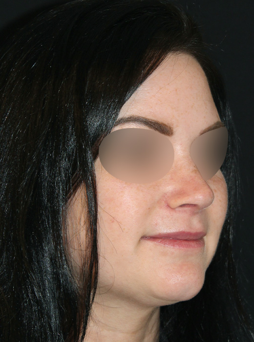 Patient 77 After Image