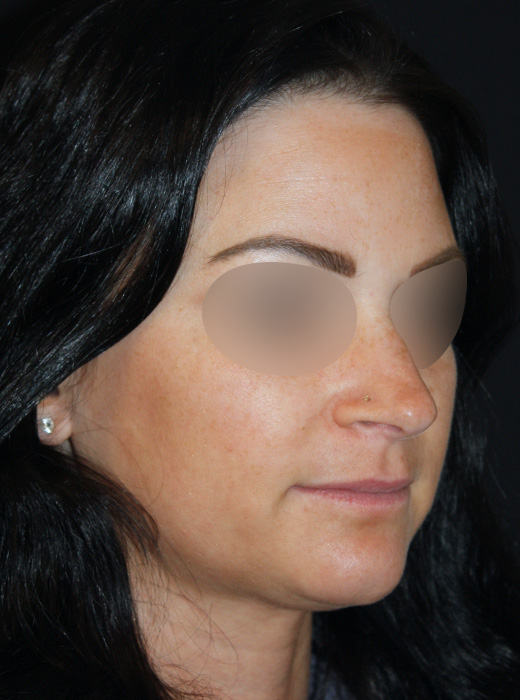 Patient 77 Before Image