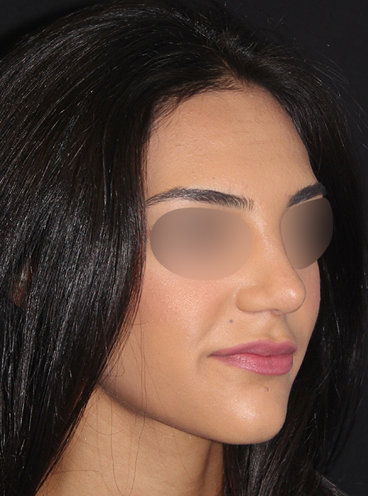 Patient 83 After Image