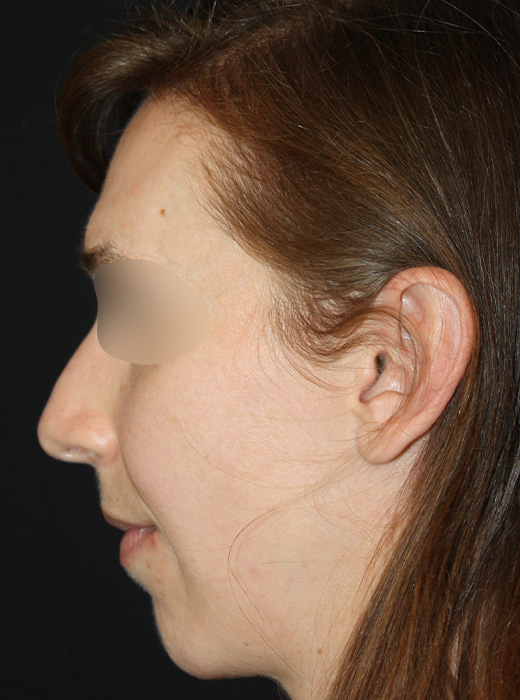 Patient 60 Before Image