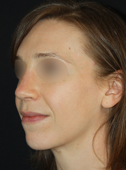 Patient 60 After Image