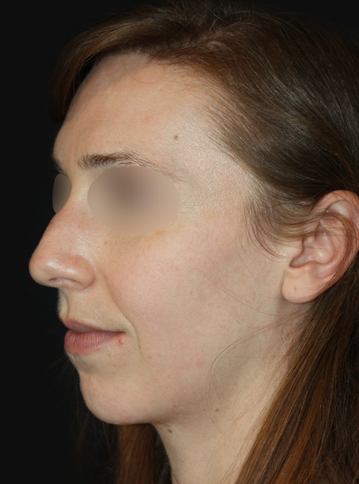 Patient 60 Before Image