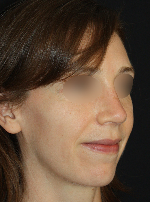 Patient 60 After Image