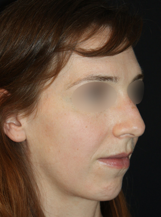 Patient 60 Before Image