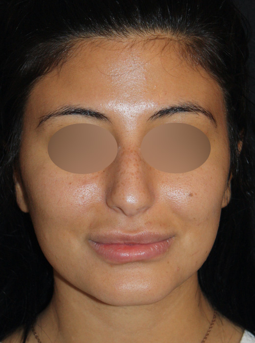 Patient 64 Before Image