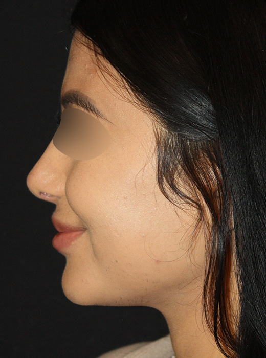 Patient 64 After Image