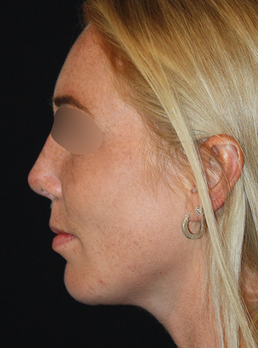 Patient 65 After Image