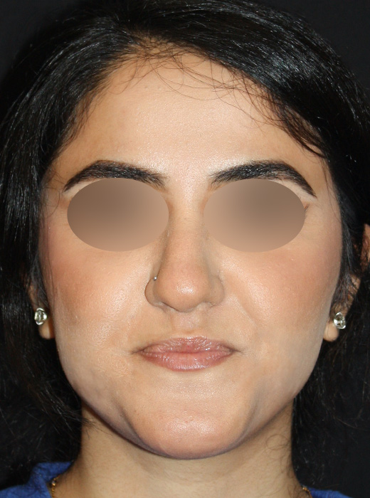 Patient 69 Before Image