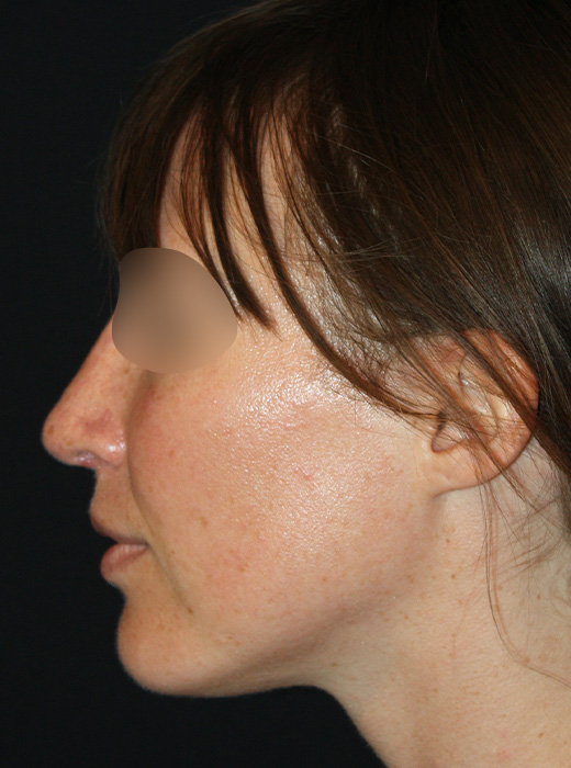 Patient 61 After Image