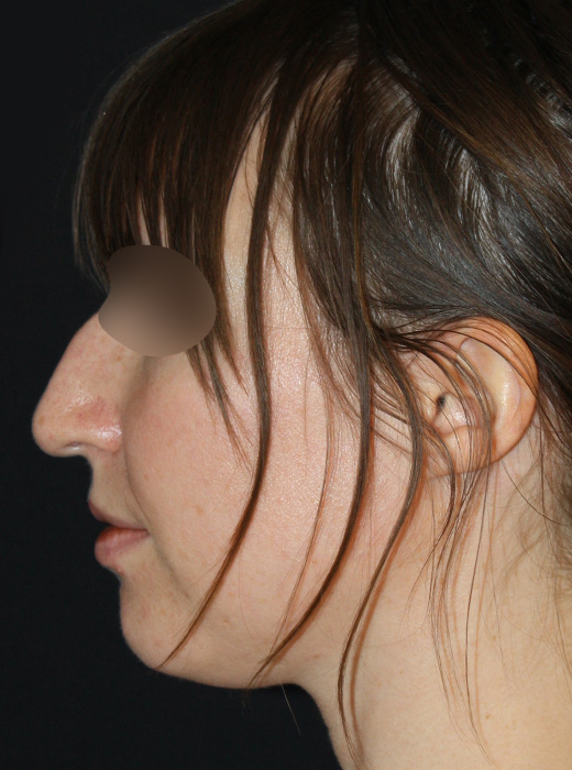 Patient 61 Before Image