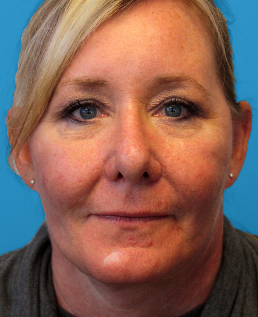 Patient 25 After Image