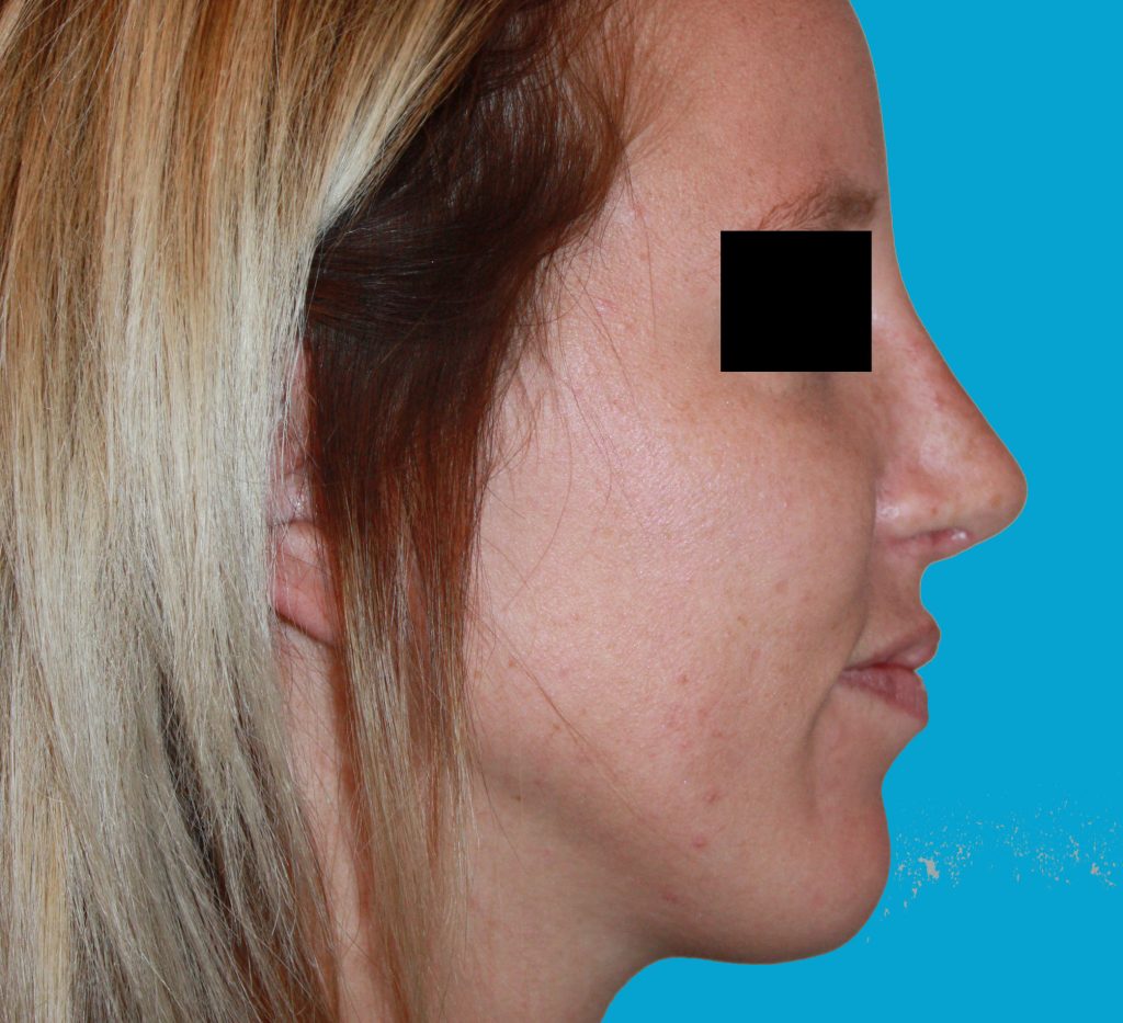 Patient 8 After Image