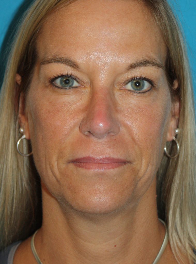 Patient 4 After Image