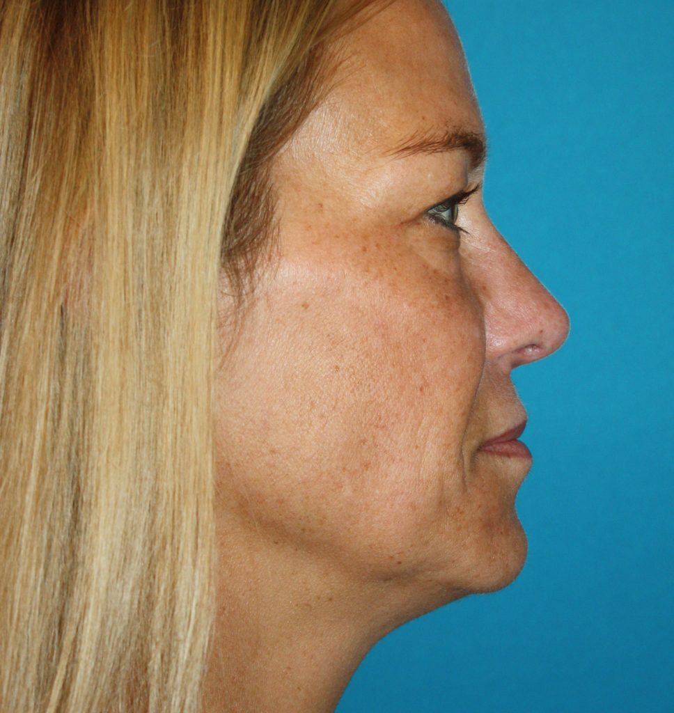 Patient 4 After Image