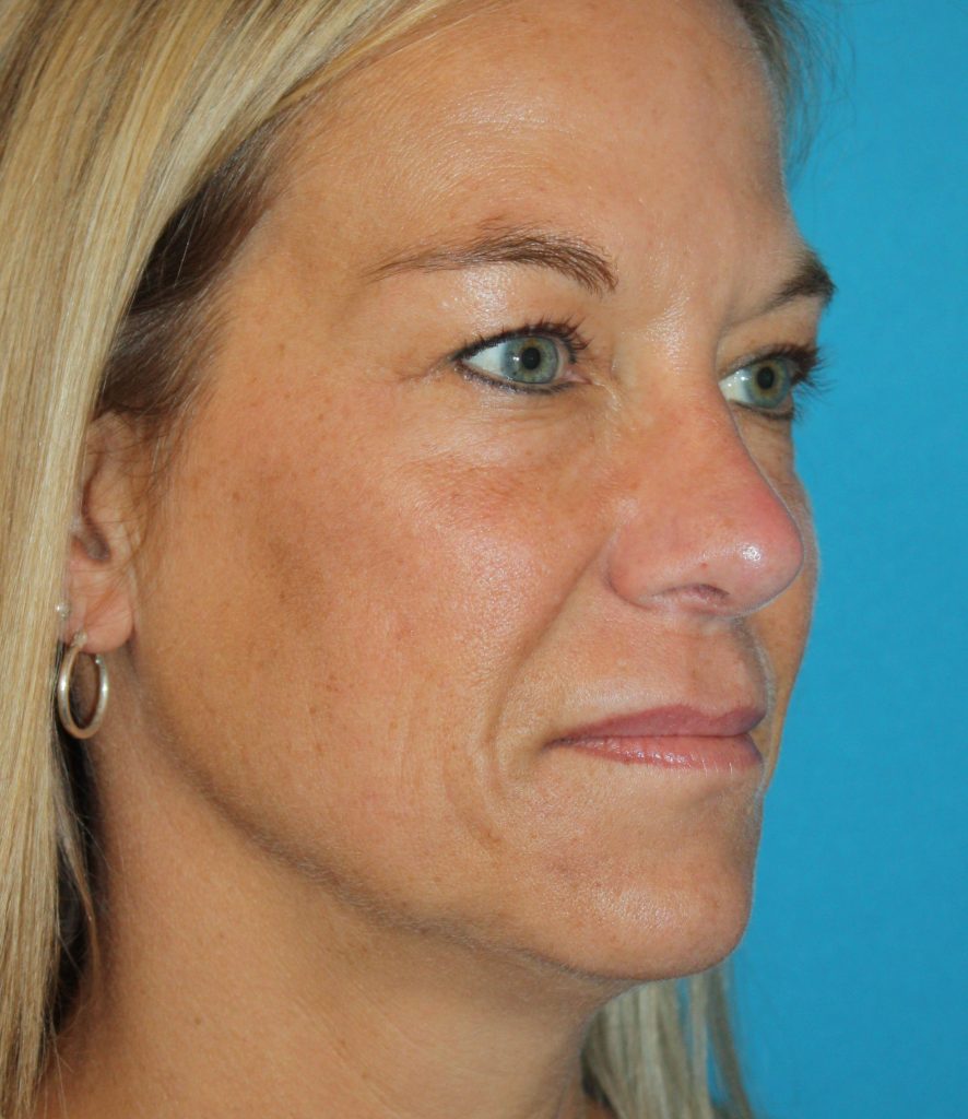 Patient 4 After Image