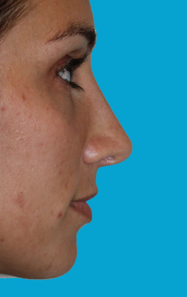 Patient 5 After Image