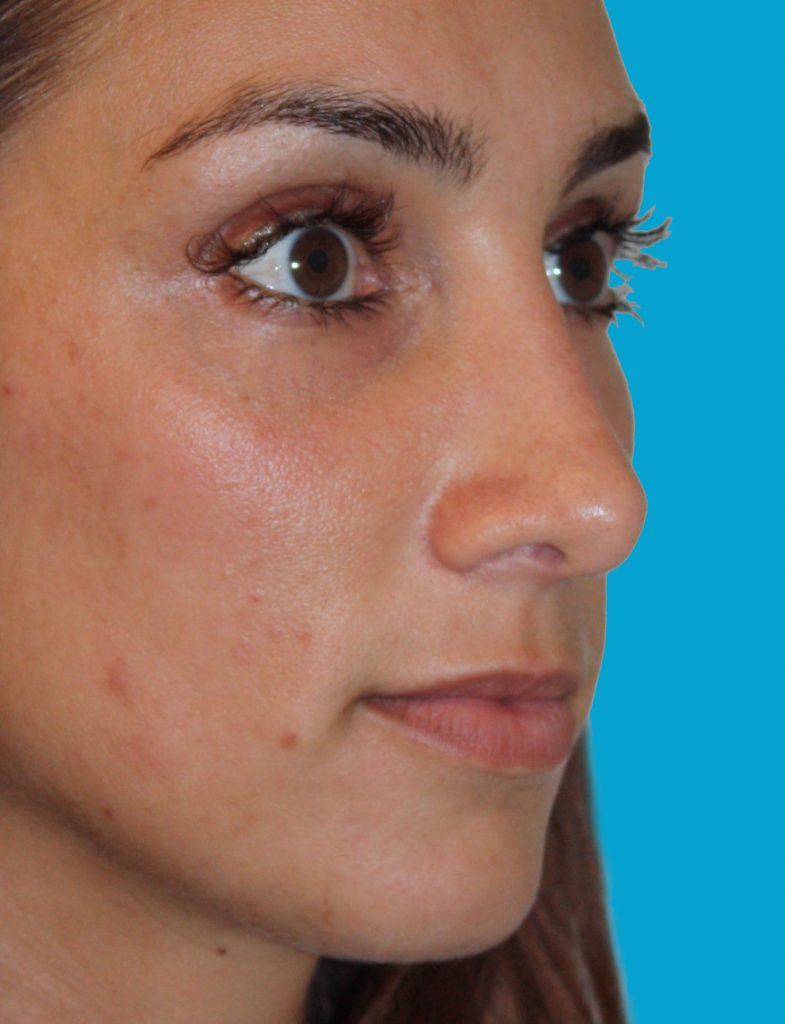 Patient 5 After Image