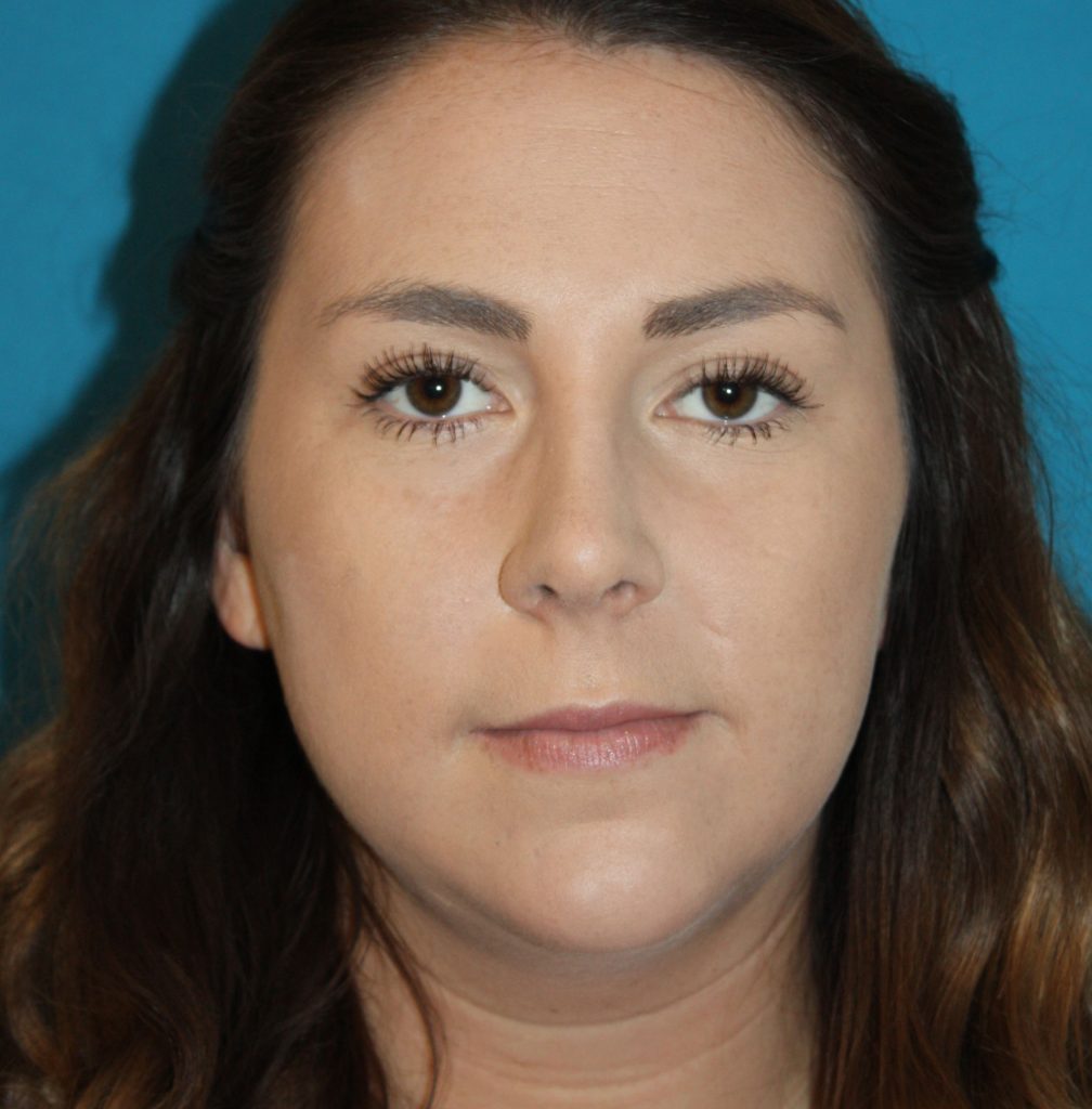 Patient 6 After Image