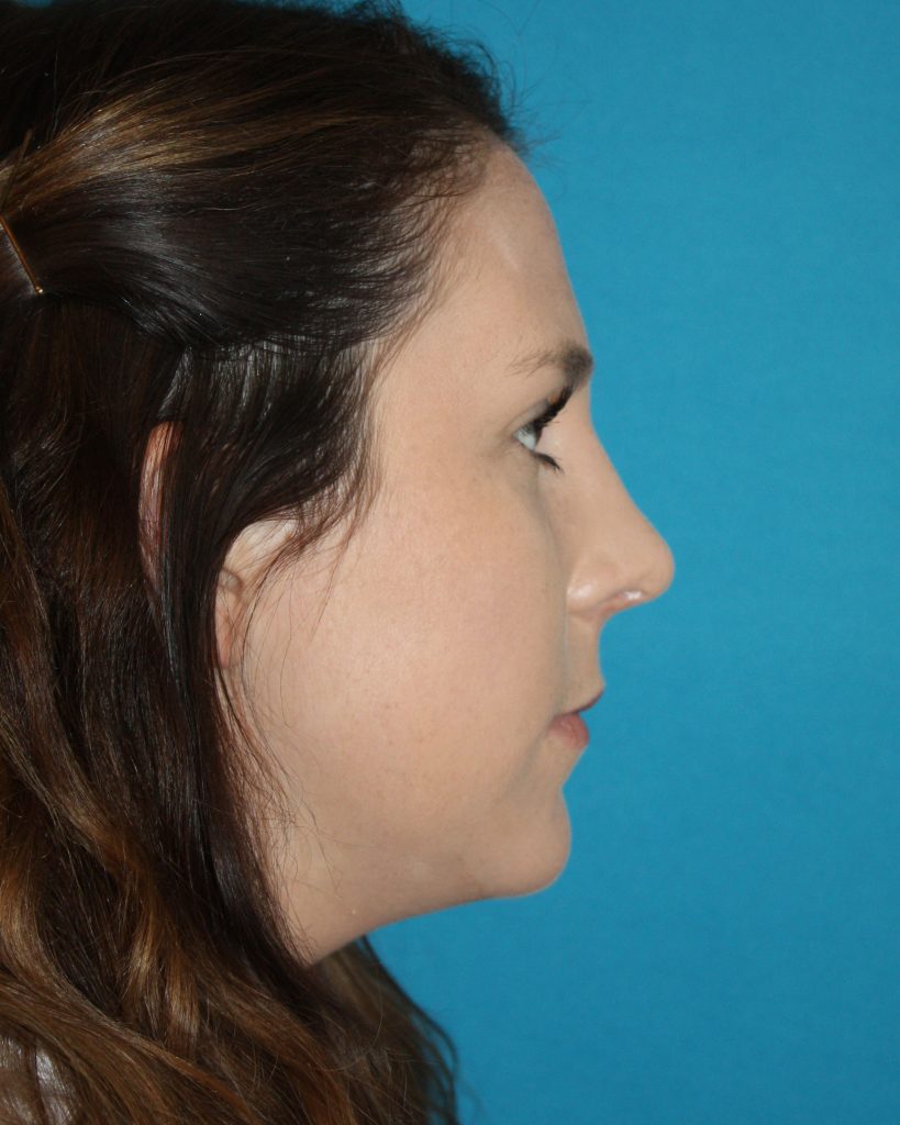 Patient 6 After Image