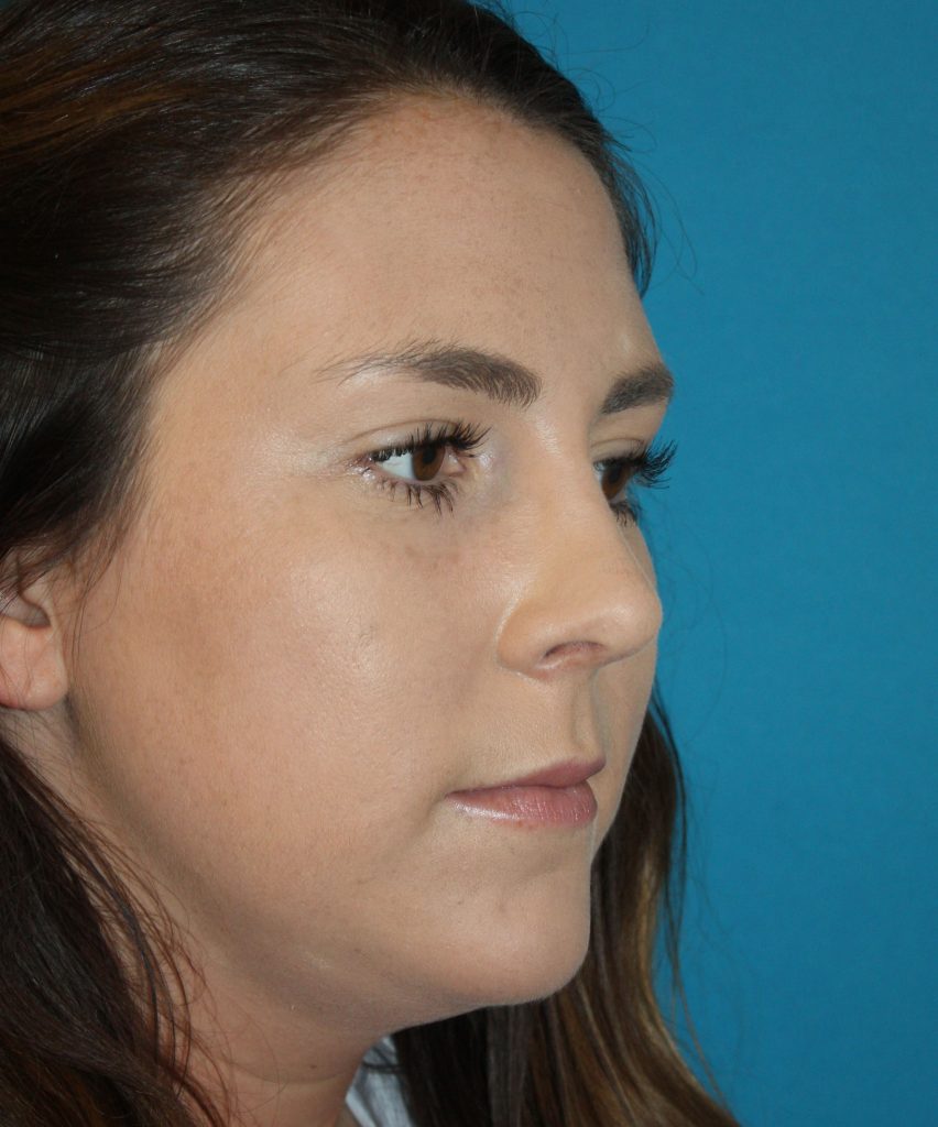 Patient 6 After Image