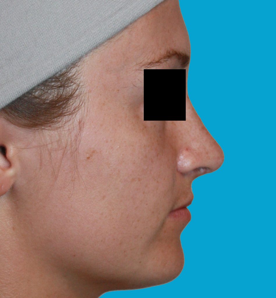 Patient 7 After Image