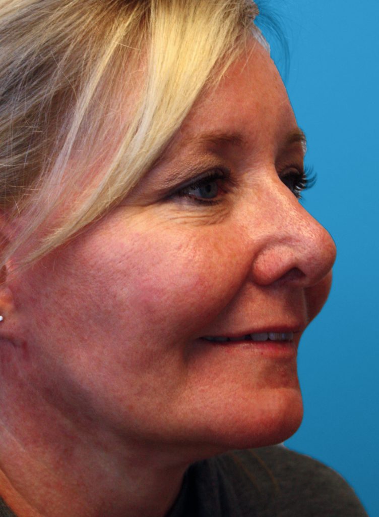 Patient 25 After Image