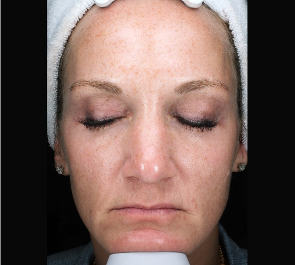 Patient 27 Before Image