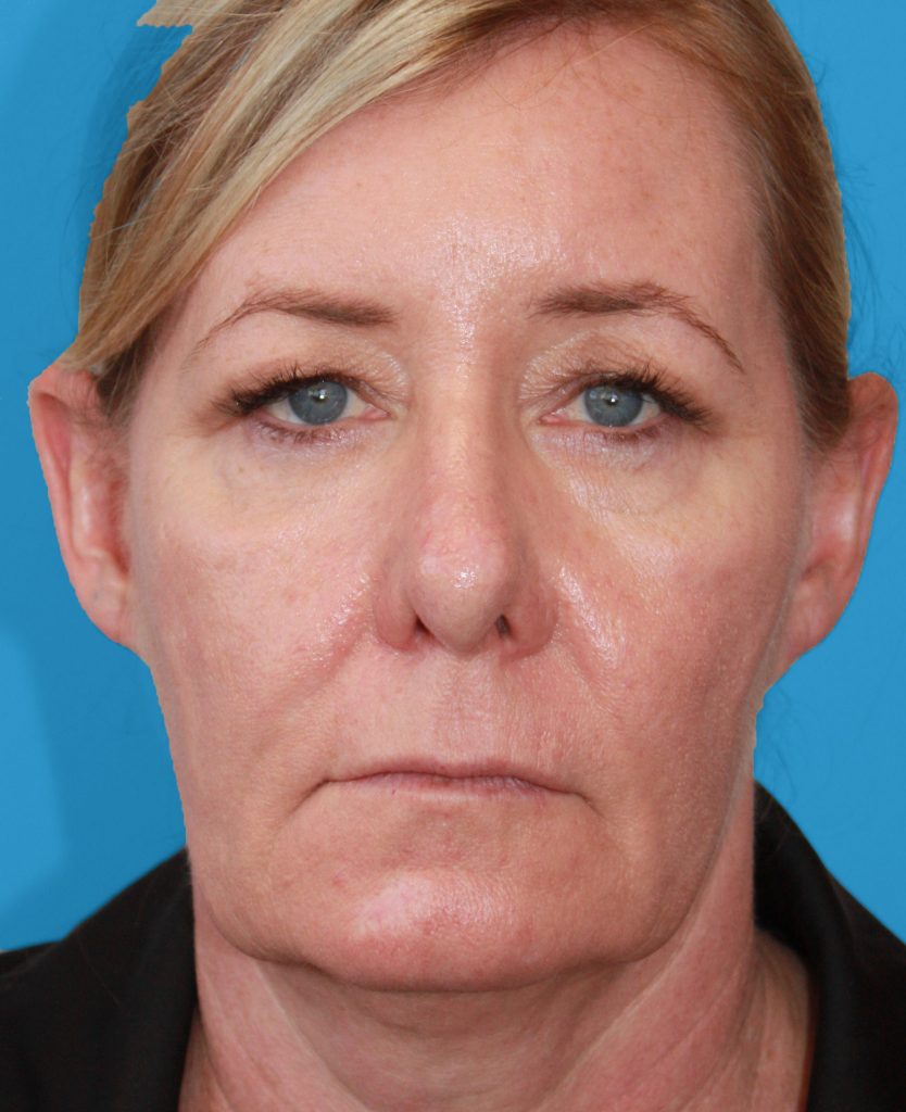 Patient 25 Before Image