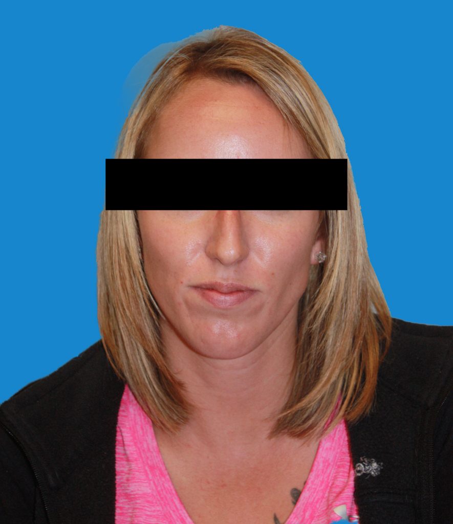 Patient 8 Before Image