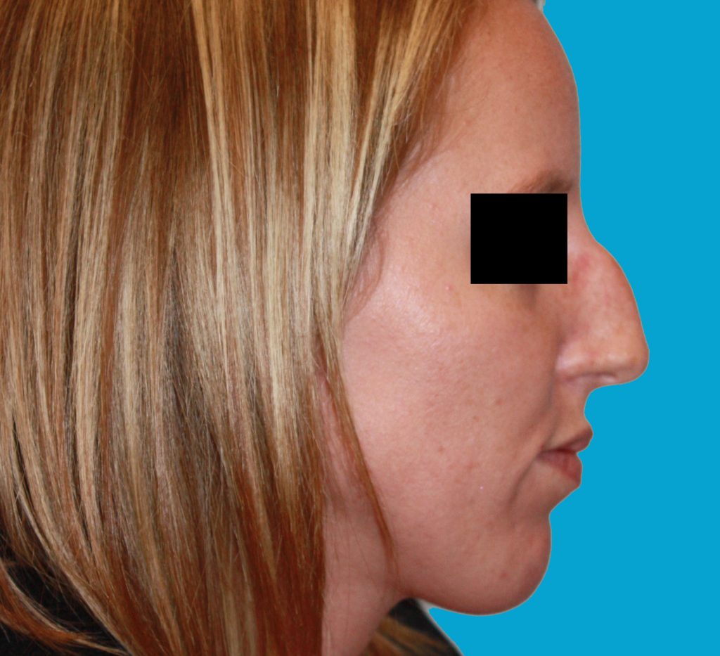 Patient 8 Before Image