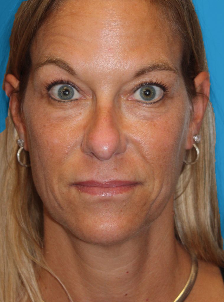 Patient 4 Before Image