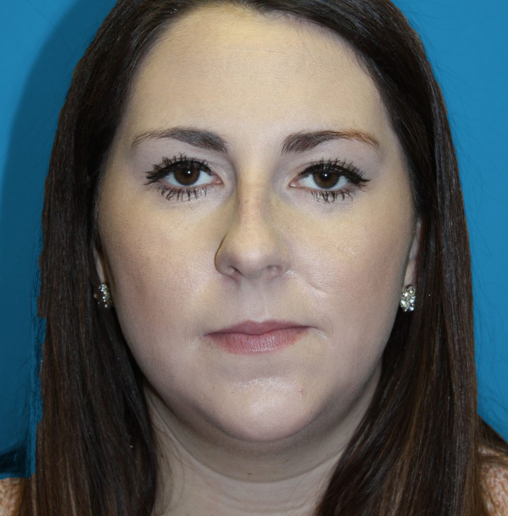 Patient 6 Before Image