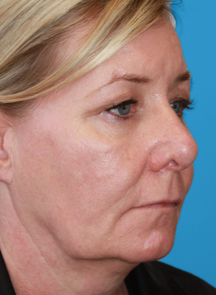 Patient 25 Before Image